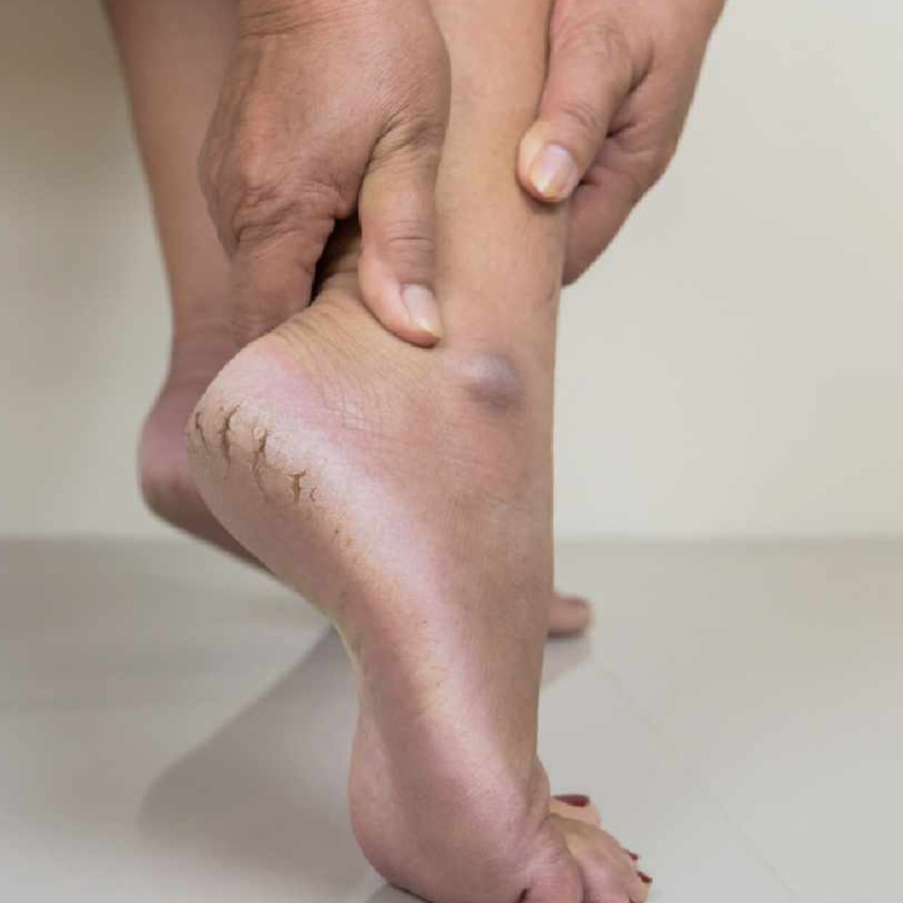 Cracked lips and heels There are easy solutions at home