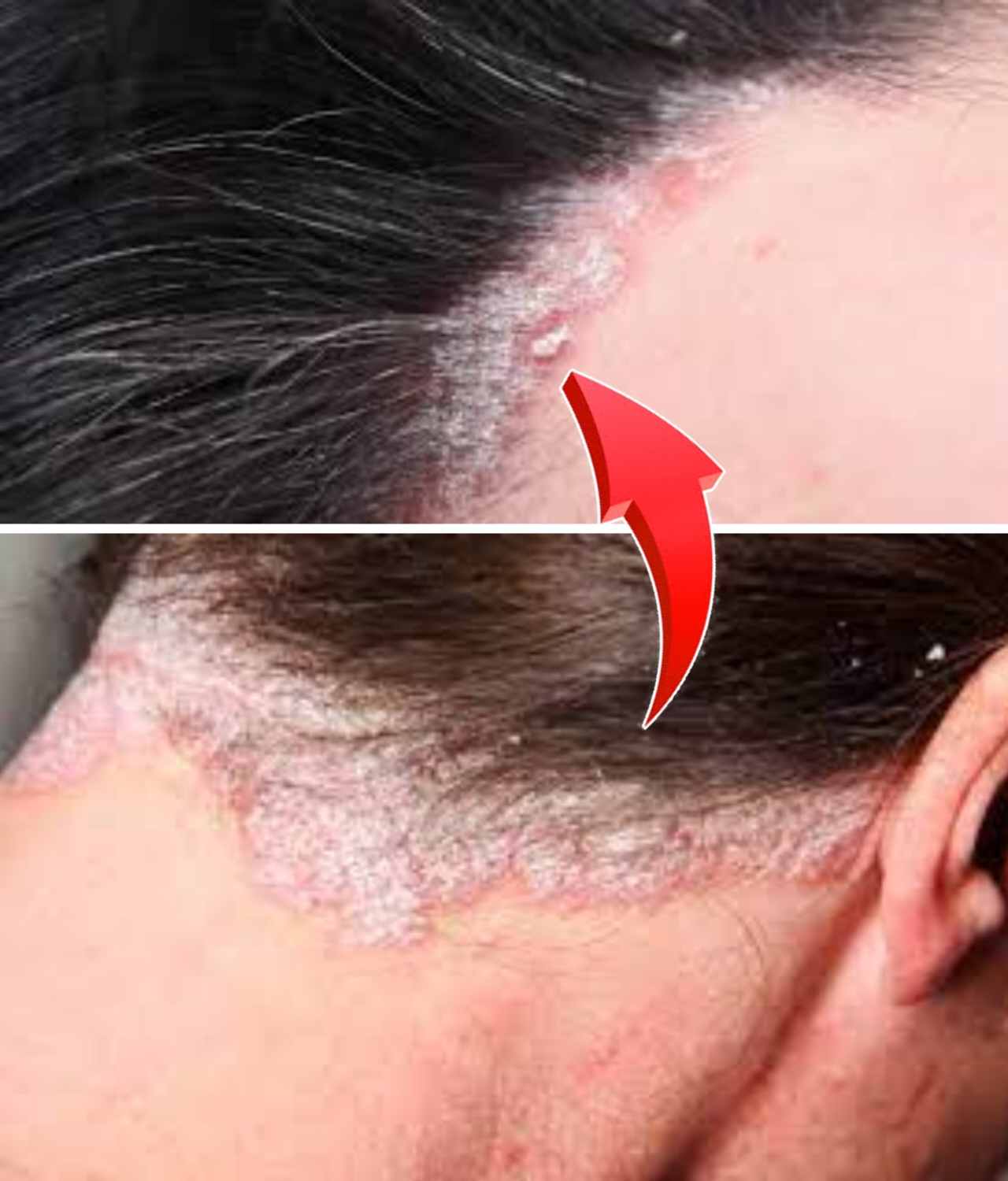 শীতে সোরিয়াসিসে ত্বকের খসখসেভাব বাড়লে কীভাবে সামলাবেন? জানুন পদ্ধতি