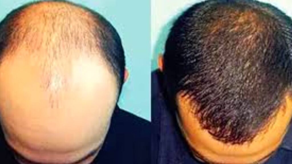 মাথাজোড়া টাক নয়, চুল ফেরাবে সঠিক খাদ্যাভ্যাস: অ্যালোপেসিয়া রোধে ৫ উপকারী খাবার