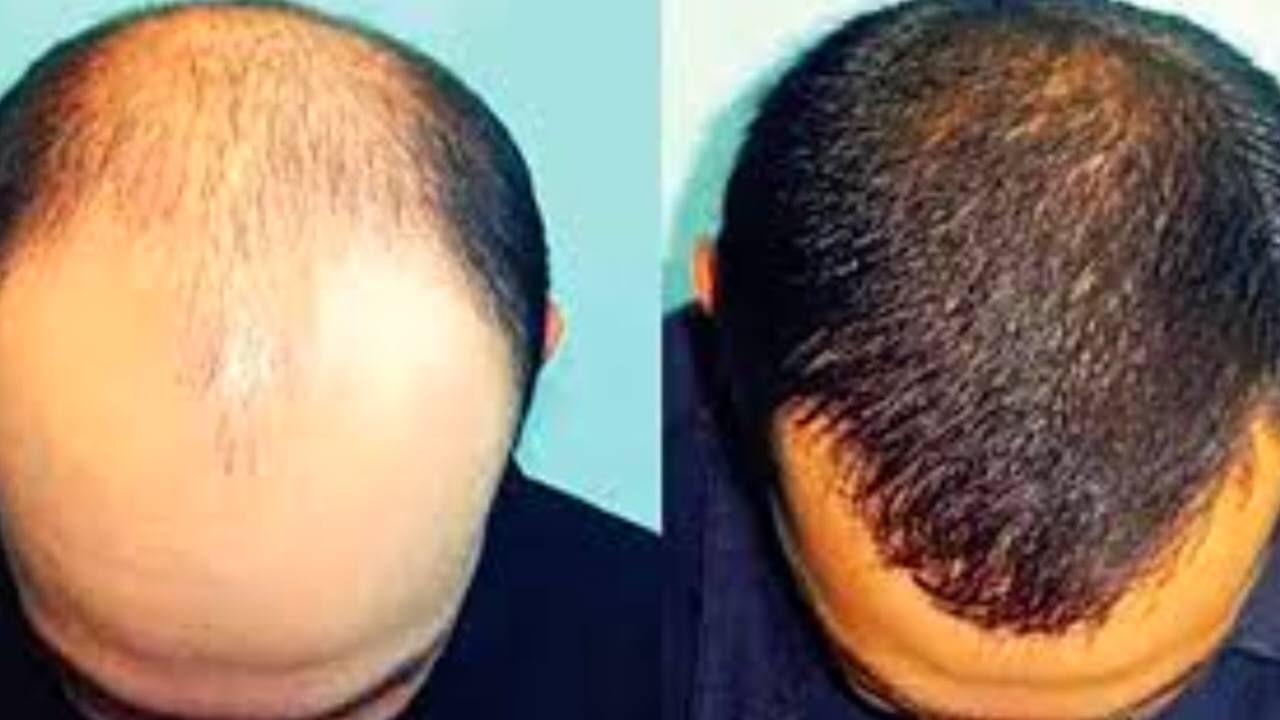 মাথাজোড়া টাক নয়, চুল ফেরাবে সঠিক খাদ্যাভ্যাস: অ্যালোপেসিয়া রোধে ৫ উপকারী খাবার