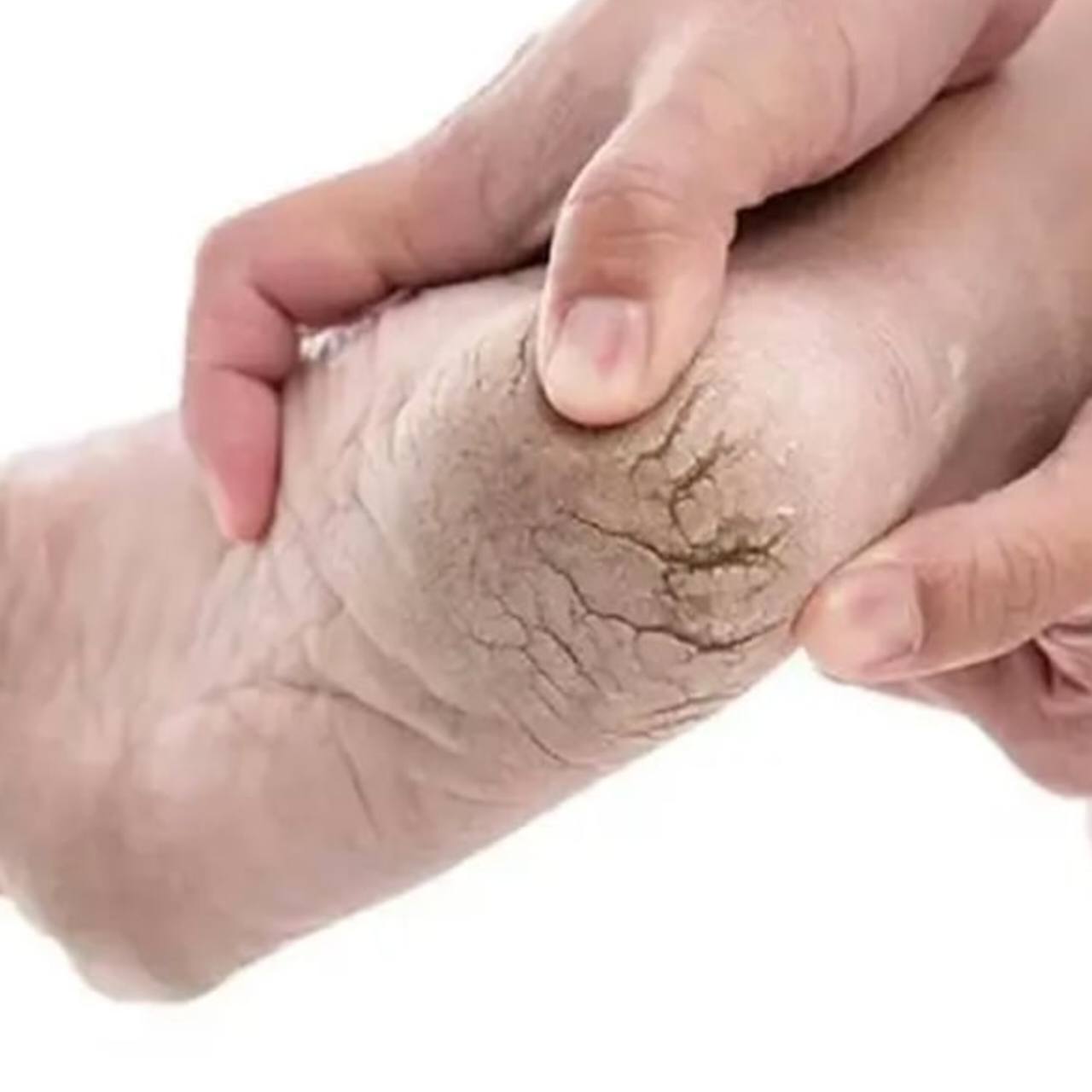 কেন পা ফাটে ও কীভাবে মিলবে দ্রুত সমাধান: শীত–গ্রীষ্মে পায়ের যত্নের পূর্ণ গাইড