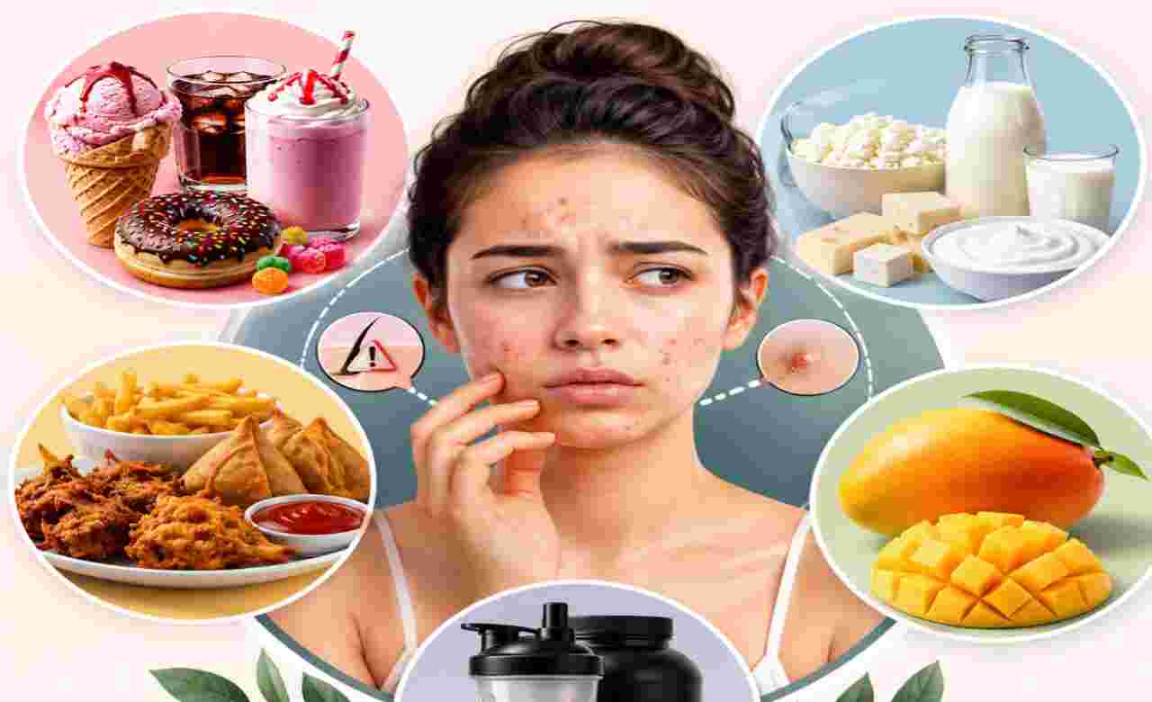 Lifestyle: গরমে বাড়ছে ব্রণের সমস্যা? দায়ী হতে পারে আপনার প্রিয় কিছু খাবারও