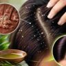 Hair Care: খুশকি বারবার ফিরে আসে কেন? কারণ জানলেই মিলবে দীর্ঘস্থায়ী সমাধান